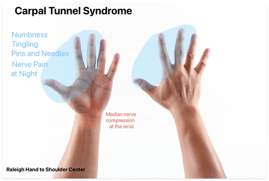 Sinaskeiðabólga (e.carpal tunnel syndrome)